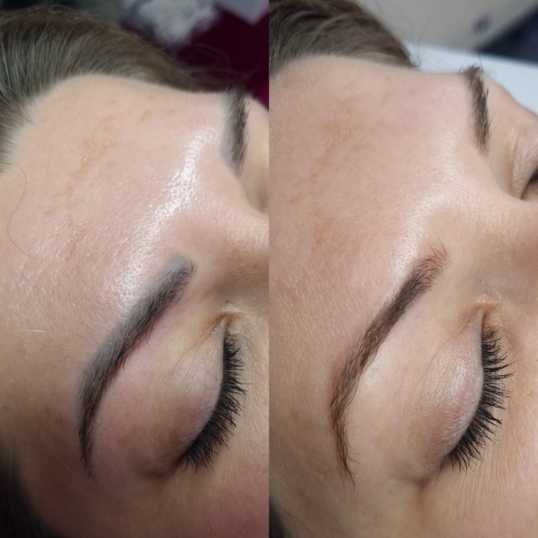 Îndepărtare tatuaj sprâncene cu laser Nd:YAG