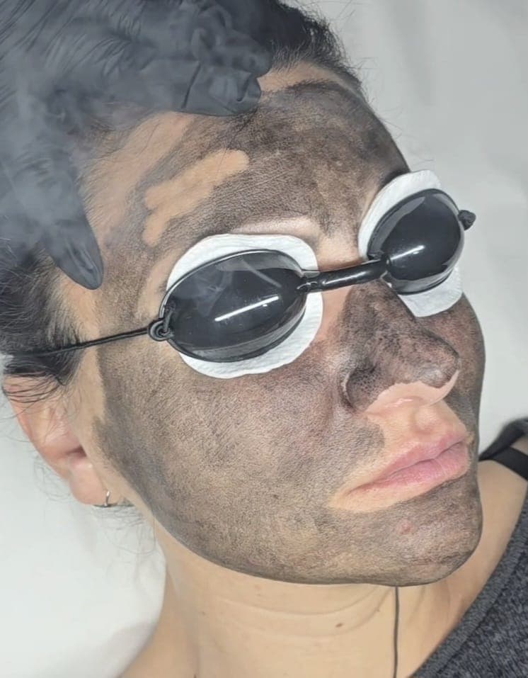 Tratament Hollywood Carbon Peel